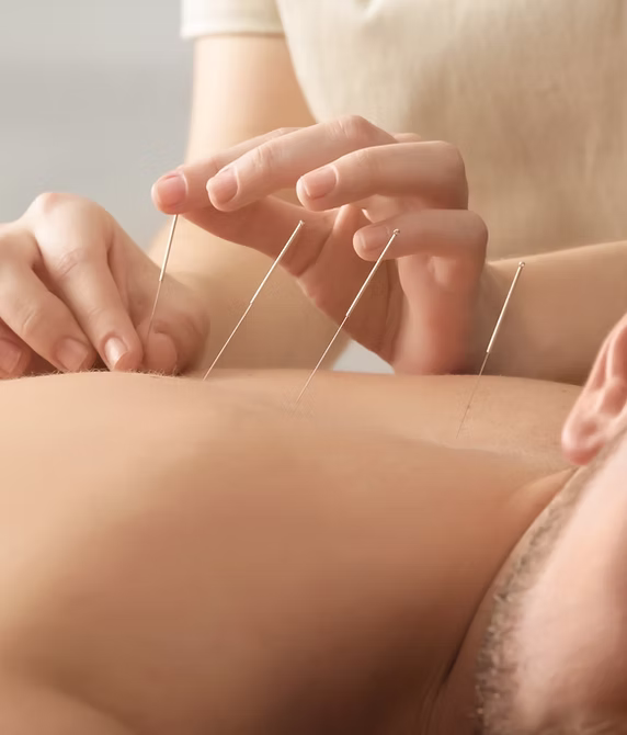 Dry Needling